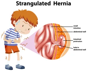 Inguinal Hernia